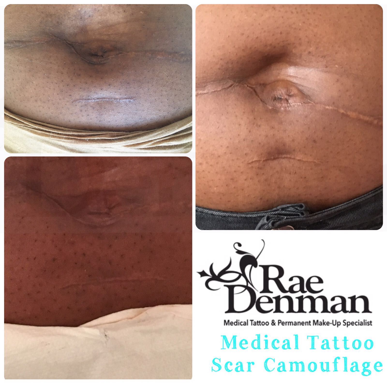 Stretch Mark Scar Camouflage - LUVLIFT Aesthetics