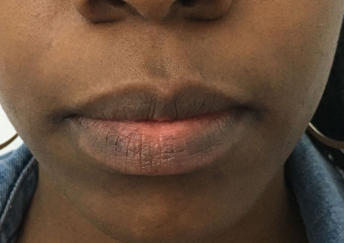 medical tattooing patchy lips before