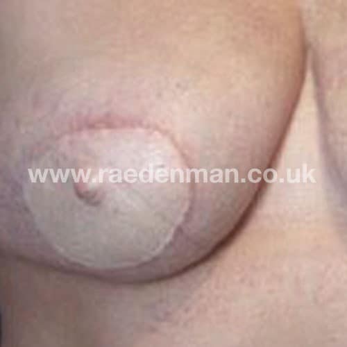 Nipple Tattoo Surrey Before