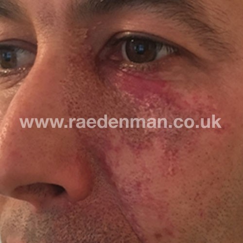 Port Wine Stain Removal London Surrey Rae Denman