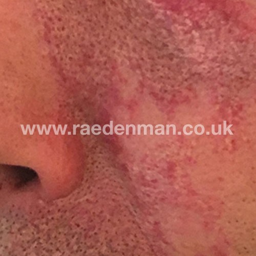 Port Wine Stain Removal London Surrey Rae Denman