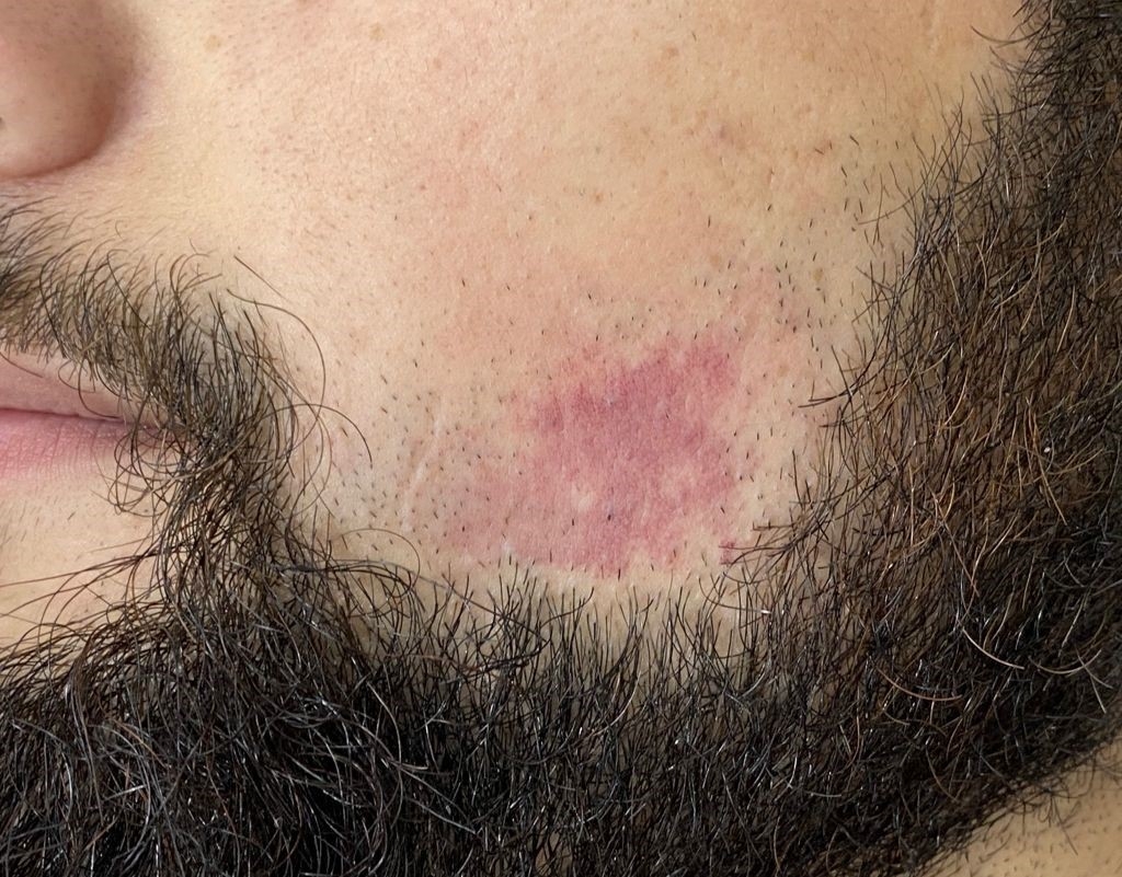 Port Wine Stain Removal London Surrey Rae Denman