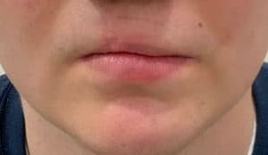 cleft lip to cupids bow
