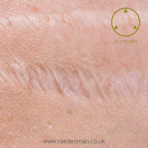 Micro-needling