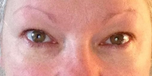 eyebrow medical tattoo before