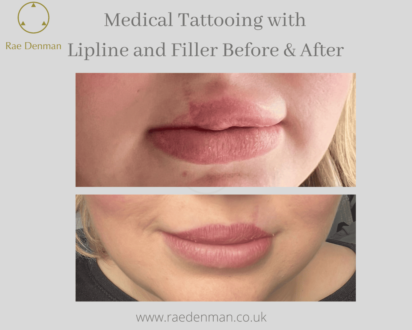 Medical Tattooing for lips to add definition and a cupids bow - Rae Denman